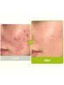 Purito Azelaic Acid 10% + Kojix Azulene Serum - 30ml