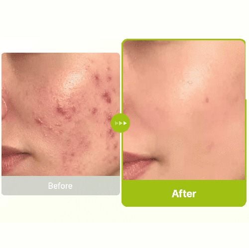 Purito Azelaic Acid 10% + Kojix Azulene Serum - 30ml
