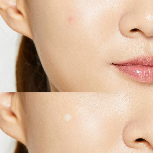 Cosrx Acne Pimple Master 24 Patches - 24 pcs 