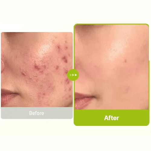 Purito Azelaic Acid 10% + Kojix Azulene Serum - 30ml