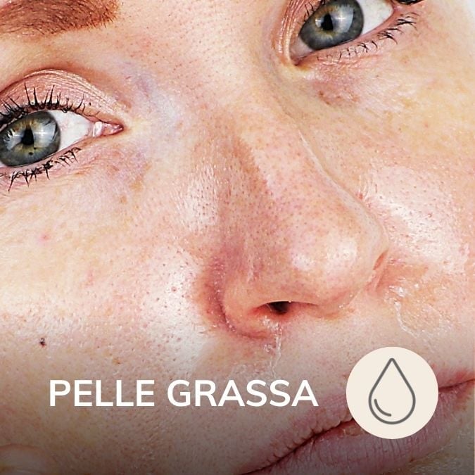 Pelle grassa