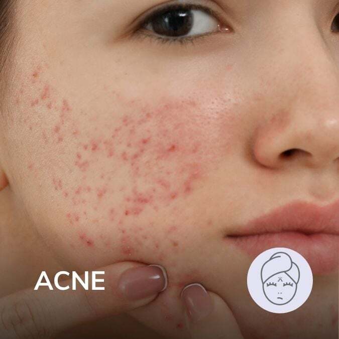 acne
